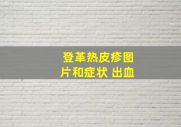 登革热皮疹图片和症状 出血